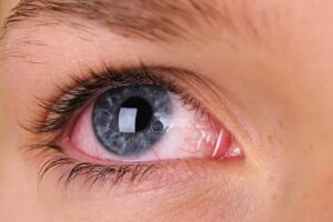red-eyes red-eyes